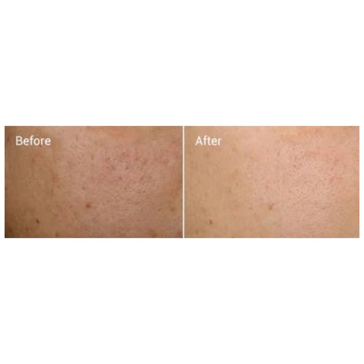 Hetrios Micro-Infusion Kit
