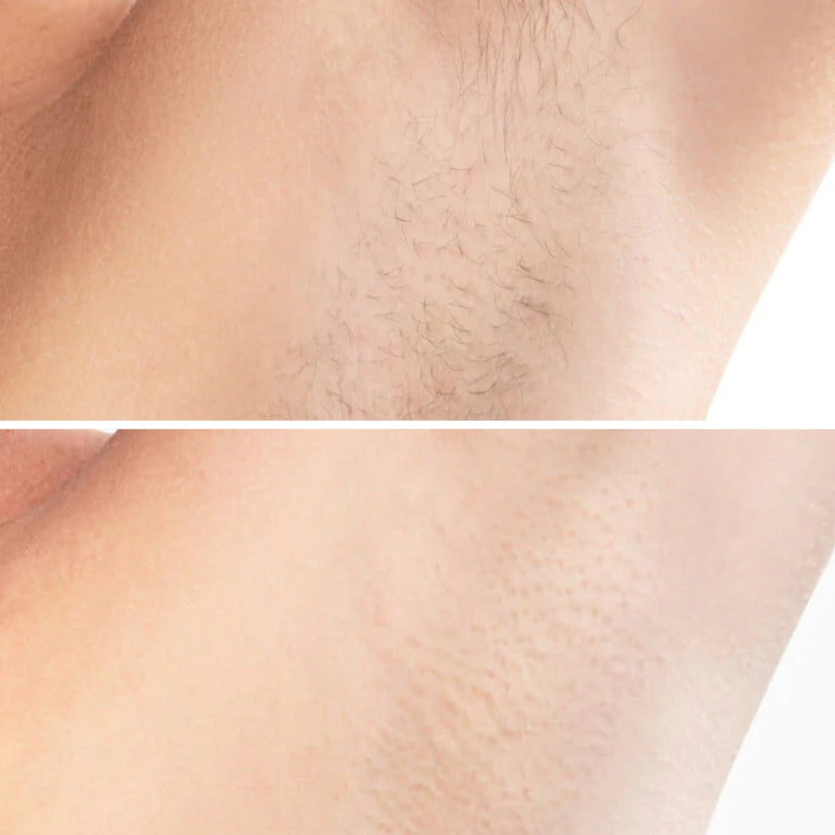 Hetrios K IPL Hair Removal Device