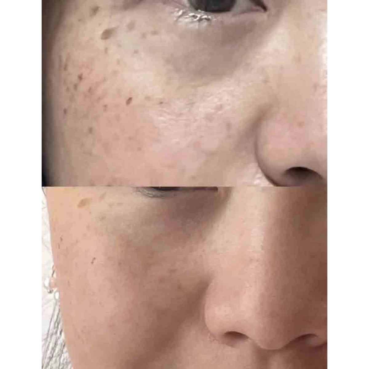 Hetrios Micro-Infusion Kit